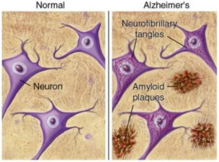 How Does Alzheimer's Affect The Brain and Body?